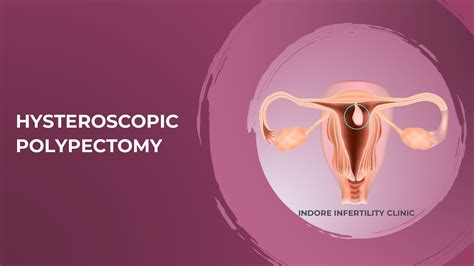 Removal Of Uterine Polyp Hysteroscopic Polypectomy How Is It Done
