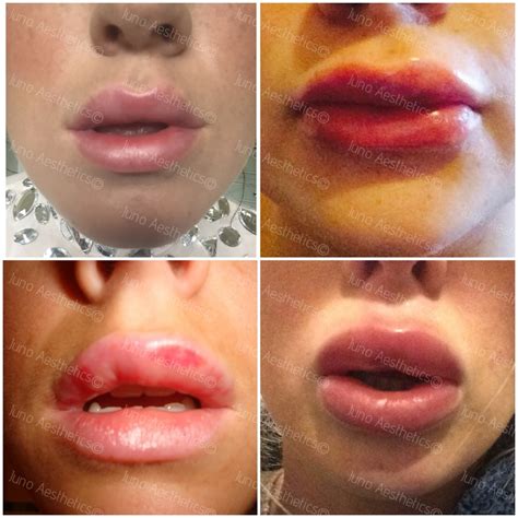 lip and facial swelling porn pics and movies