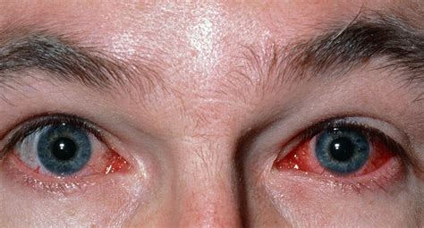 Eye Diseases Pictures