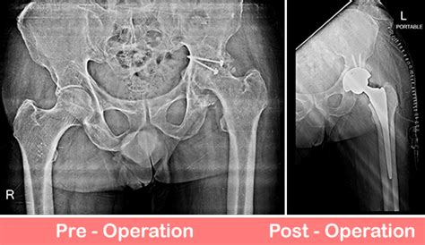 deformity correction  uncemented total hip replacementthr
