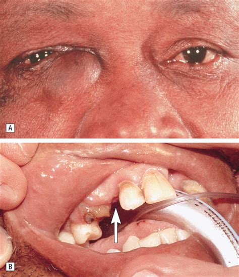 eye tooth  case  orbital dentigerous cyst  trauma jama
