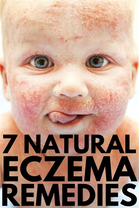 natural eczema treatment  natural ways  treat eczema  work