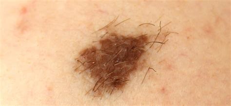 The Different Types Of Moles You Should Know About Sk N Clinics