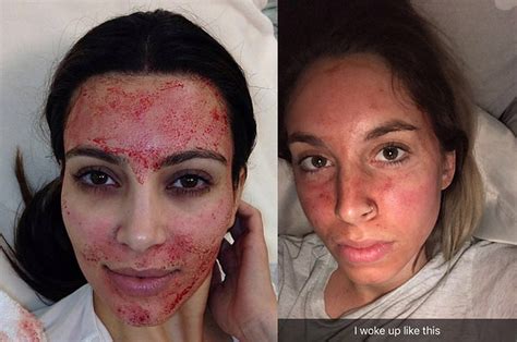 This Is What Getting A Vampire Facial Is Actually Like