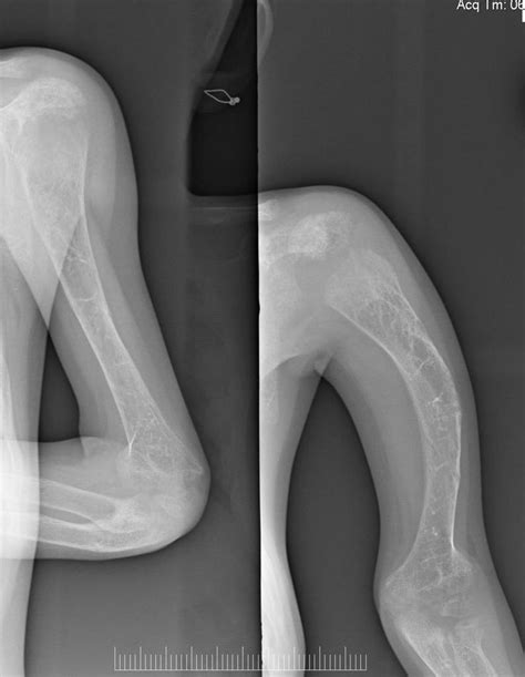 Osteogenesis Imperfecta Radiology Case