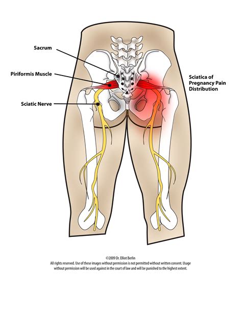 Sciatic Nerve Pain Sciatica Is A General Term For Pain Originating