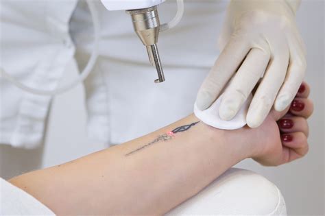 laser tattoo removal work  facts