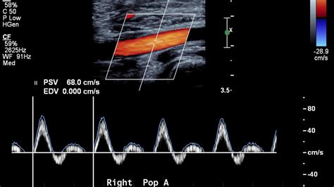 doppler ultrasound vitalim