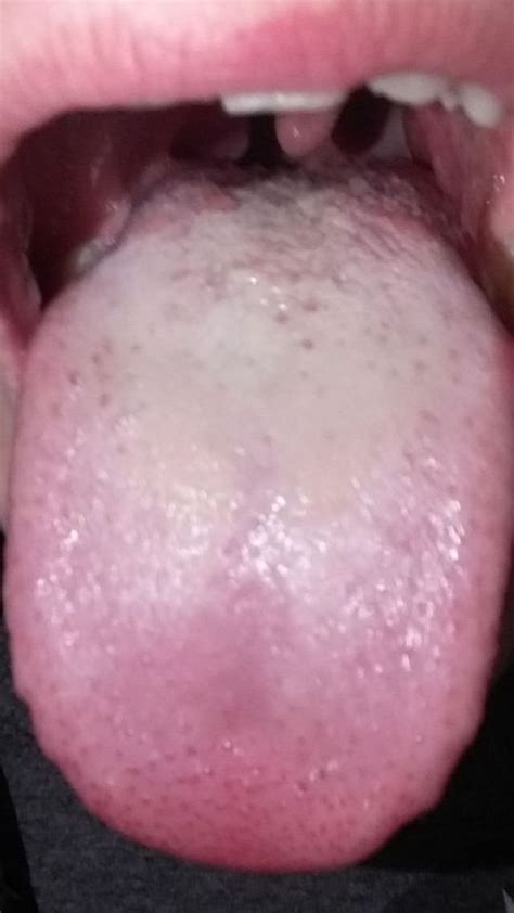 White Tongue At Candida And Dysbiosis Forum Topic 2386689