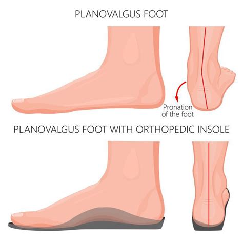 Orthotics Are Good For Your Feet Ankle And Foot Centers Of Georgia