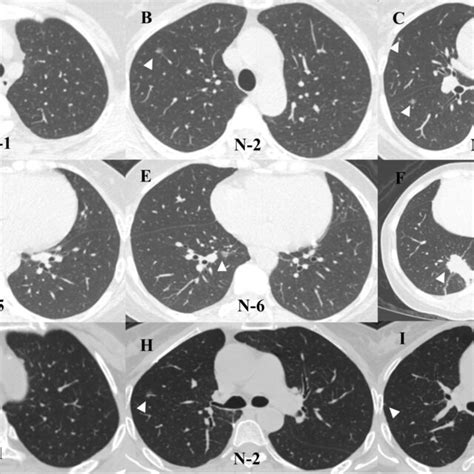 Chest Ct Scan Finding Of The Patient A–f The Right Upper Lobe Shows
