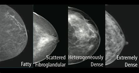 cancer detection should doctors inform patients of breast density