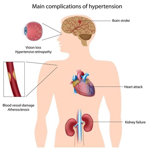 hypertension cardiology highland hospital university  rochester