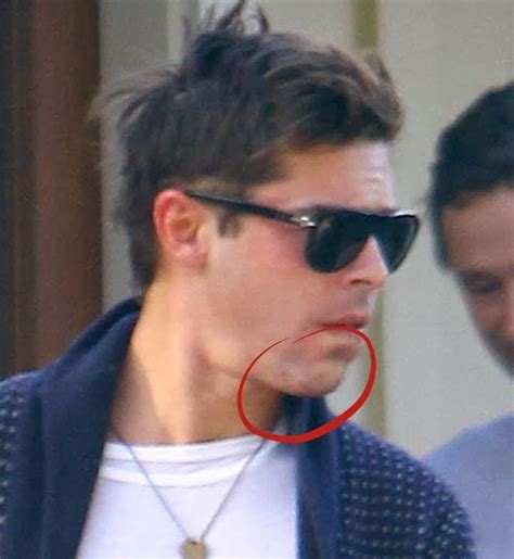 first photo s of zac efron after breaking his jaw