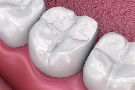 composite tooth colored fillings northwoods dental spa