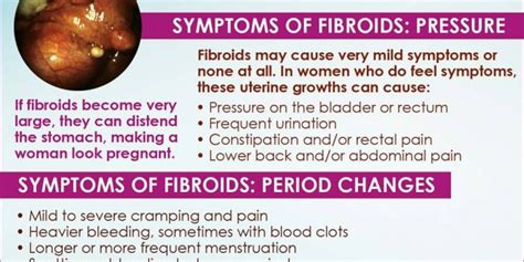 Are There Natural Solution To Get Rid Of Uterine Fibroids
