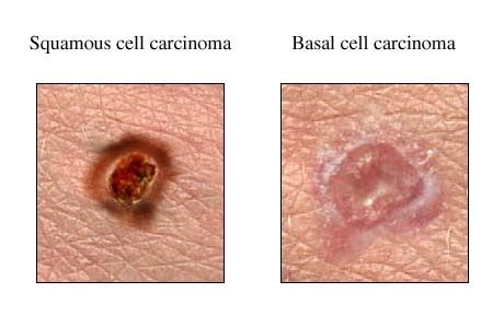 australian researchers find   genetic    melanoma skin cancers scimex