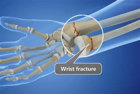 surgery   wrist fracture     southern hand