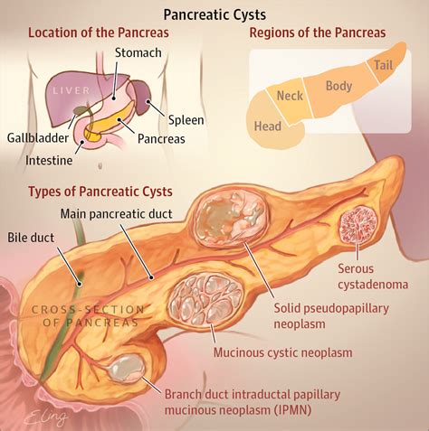types  pancreatic cysts gastroenterology jama jama network