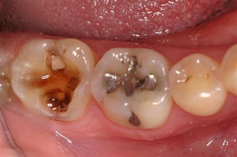 dental cavities     brighton dental labs