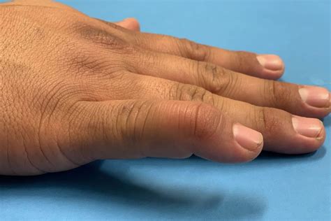 Mallet Finger Hand Therapy Group