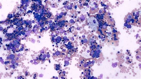 A Rare And Serious Cause Of Pancytopenia In A Patient With Systemic