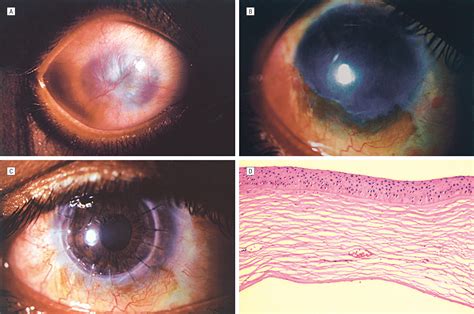 Early Results Of Penetrating Keratoplasty After Cultivated Limbal