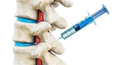 facet injections  relieve chronic  pain total spine ortho