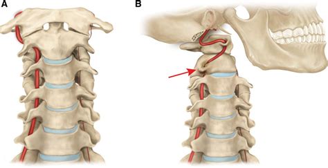 Rotational Vertebral Artery Occlusion Stroke