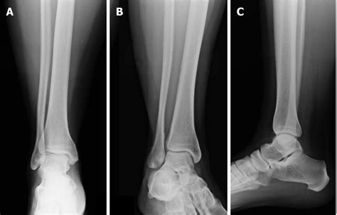acute syndesmotic injuries  ankle fractures  diagnosis