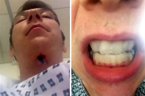 teeth whitening kit left man with hole in throat after