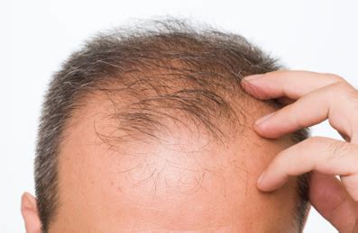 vitamin deficiency  hair loss  facts progressivehealthcom