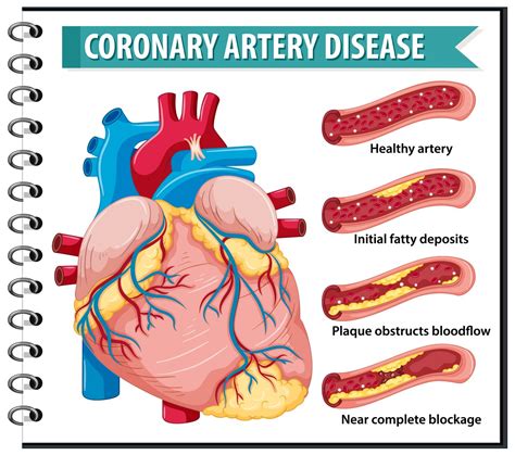 interpret coronary artery blockage cardiovascular disorders