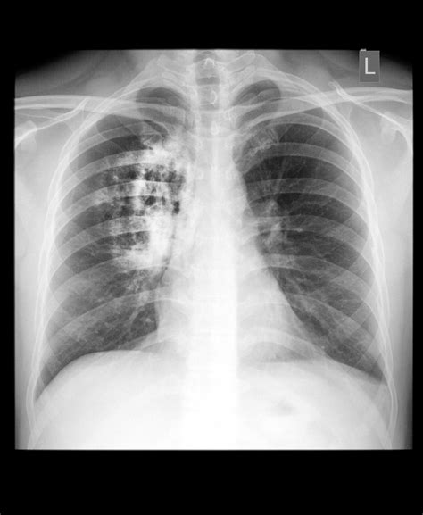 lung cancer lung cancer symptoms medlineplus