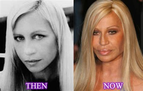 Donatella Versace Plastic Surgery Nose Job Face Lift Lip Augmentation