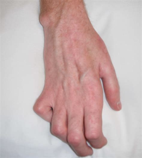claw hand  signs symptoms diagnosis  claw hand treatment