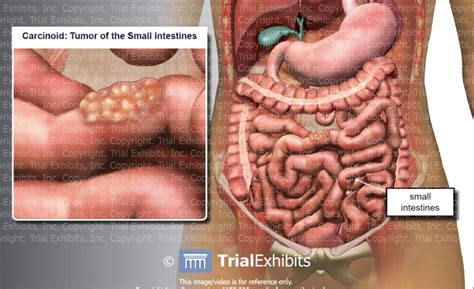 carcinoid tumor of the small intestines trialexhibits inc