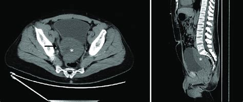 transplant kidney partial torsion axial  sagittal  contrast  scientific diagram