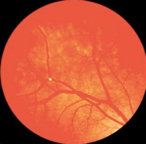 wet amd increases risk  rvo fivefold