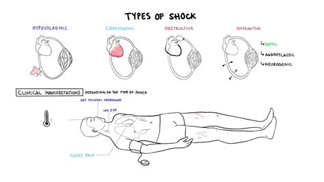 approach  shock types hypovolemic cardiogenic distributive