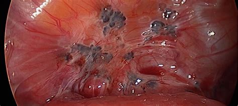 la endometriosis dr rolando r pinilla jaén ginecología
