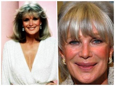 linda grey plastic surgery before and after photos ~ celebrity plastic surgery news before and