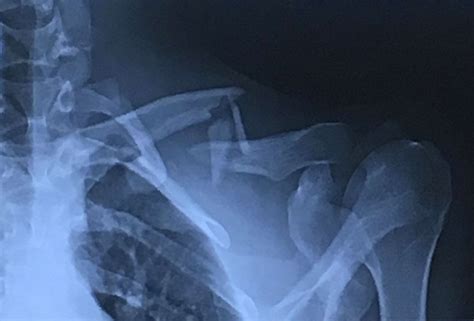 clavicle fracture treatment   surgery