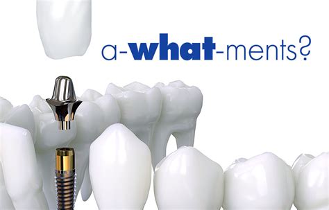 dental implant abutment  dental blog