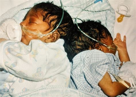 Conjoined Twins We Always Knew We Were Different Bbc News