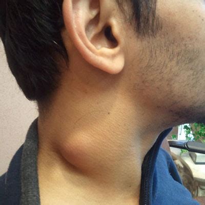neck lump british association  oral  maxillofacial surgeons