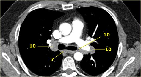 Mediastinal Lymph Node Stations Radiographics News Current Station In