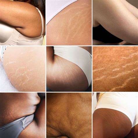 Stretch Marks Happen Why Do Women Have To Love Them Too