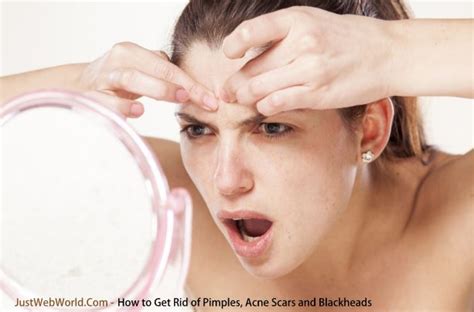 rid  pimples acne scars  blackheads  web world