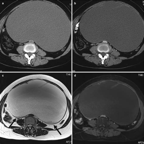 Tomographic And Magnetic Resonance Imaging Of Borderline
